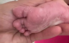 Bé gái 3 tháng tuổi mắc giang mai bẩm sinh do mẹ nhiễm bệnh khi mang thai