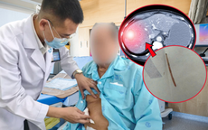 Người đàn ông sốc nhiễm trùng, bác sĩ phát hiện xương cá nằm trong gan