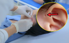 Lỗ nhỏ trước tai khiến cô gái 17 tuổi nhiều năm liên tục viêm nhiễm, áp xe
