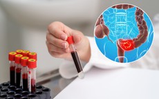 Ung thư đại trực tràng có chữa được không?