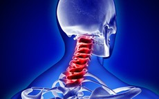 Ai cần thận trọng hoặc không nên tự ý kéo giãn cột sống cổ?
