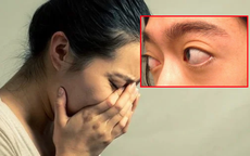 Mắt lồi bất thường, người phụ nữ phát hiện khối u nằm sâu sau nhãn cầu