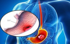 6 dấu hiệu cảnh báo ung thư dạ dày cần biết