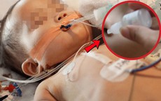 Bé gái 19 tháng tuổi cấp cứu ngưng thở vì ngộ độc thuốc nhỏ mũi
