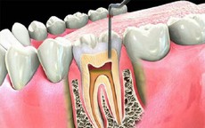 Viêm quanh răng gây hệ lụy gì?

