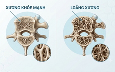 Nguy cơ gây loãng xương: Trường hợp nào cần chủ động đánh giá sức khỏe xương?