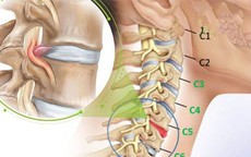 Tê tay khi ngủ chữa thế nào?