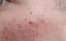 5 cách chăm sóc da và hạn chế trứng cá đỏ tái phát