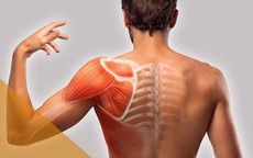 Viêm quanh khớp vai cần xử trí như thế nào?
