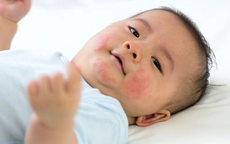Làm sao biết con bạn bị dị ứng sữa?