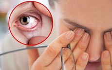 Chăm sóc người bị xuất huyết dưới kết mạc tại nhà