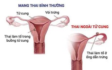 Thử thai 2 vạch, vì sao cần phải đi siêu âm sớm?
