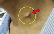 Cổ sưng đau, không thể ăn uống suốt nhiều ngày, bác sĩ phát hiện điều bất ngờ
