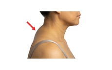 2 bài tập đơn giản tại nhà giúp cải thiện tư thế gù cổ