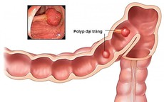 Polyp đại tràng được chẩn đoán như thế nào?