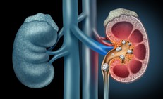 Những th&#243;i quen g&#226;y sỏi thận &#237;t người biết