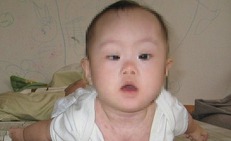 Trẻ mệt bất thường c&#243; thể mắc rối loạn nhược cơ bẩm sinh