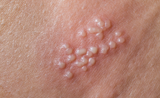 Nguyên nhân gây bệnh mụn rộp sinh dục