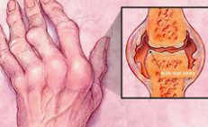 Vi&#234;m khớp dạng thấp ảnh hưởng đến cơ thể như thế n&#224;o?