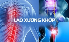 Ai l&#224; người dễ bị lao xương khớp?