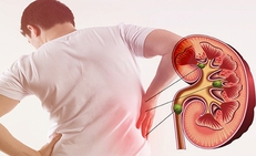 Đau lưng &#226;m ỉ một năm, người đ&#224;n &#244;ng 54 tuổi ph&#225;t hiện thận bị ph&#225; hủy bởi sỏi san h&#244; khổng lồ