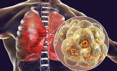 4 triệu chứng điển h&#236;nh cảnh b&#225;o mắc vi&#234;m phổi