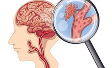 Các dấu hiệu đột quỵ dễ bị bỏ qua khi trời lạnh