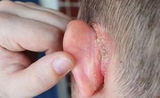 Vành tai đỏ, ngứa, khô da và bong tróc cảnh giác với bệnh chàm tai