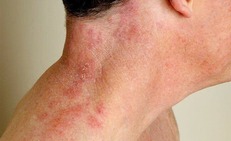 Lý do người lớn tuổi dễ mắc bệnh zona thần kinh