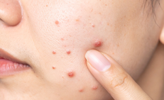 Thủ phạm gây mụn ở thời kỳ mãn kinh