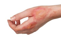 Hội chứng Lyell: Nguy&#234;n nh&#226;n, biểu hiện, c&#225;ch điều trị v&#224; ph&#242;ng bệnh