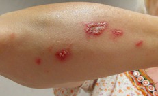 M&#249;a h&#232; cảnh gi&#225;c với bệnh da do c&#244;n tr&#249;ng