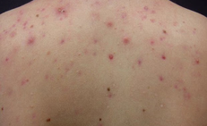 N&#243;ng gan g&#226;y nổi mụn lưng?