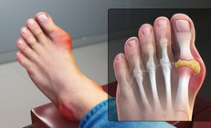 Người c&#243; nguy cơ cao mắc bệnh gout cần lưu &#253; g&#236;?