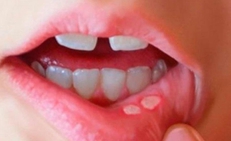 L&#253; do khiến trẻ bị nhiệt miệng v&#224; c&#225;ch khắc phục