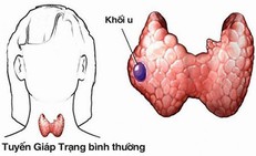 Ai c&#243; nguy cơ cao mắc ung thư tuyến gi&#225;p?