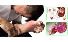 Bệnh gout ảnh hưởng thế n&#224;o đến tim, thận?