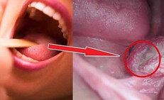 Dấu hiệu điển h&#236;nh của ung thư khoang miệng ở giai đoạn sớm