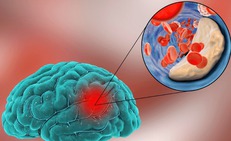 Nhồi m&#225;u n&#227;o cấp do đ&#226;u?