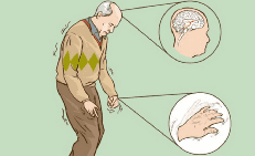 Biểu hiện cho thấy bạn mắc bệnh Parkinson