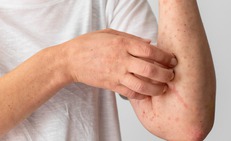C&#225;c biện ph&#225;p ph&#242;ng ngừa vi&#234;m da cơ địa 