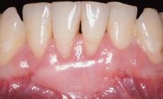 Những điều nên và không nên sau ghép lợi