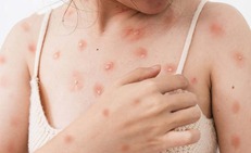 Cảnh báo thủy đậu ở người lớn có thể gây biến chứng nguy hiểm