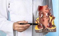 Trĩ nội độ 2 có cần mổ không?