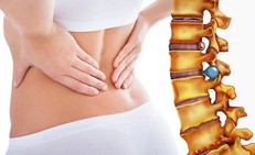 Thoát vị đĩa đệm khi nào cần phẫu thuật?