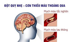 5 dấu hiệu nhận biết sớm cơn thiếu máu não thoáng qua