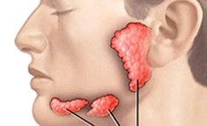 Sưng đau dưới lưỡi, cảnh giác với sỏi tuyến nước bọt