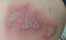 Viêm da tiếp xúc do kiến ba khoang, cách xử trí đúng tránh lan rộng