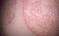 5 nguyên tắc quan trọng giúp phòng ngừa nấm da