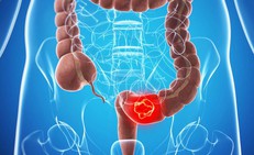 Sau 60 tuổi mắc ung thư đại trực tràng cần làm gì?